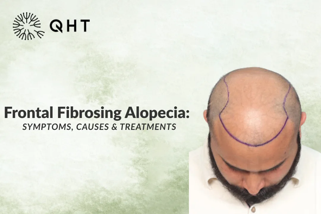 Frontal Fibrosing Alopecia: Symptoms, Causes & Treatments