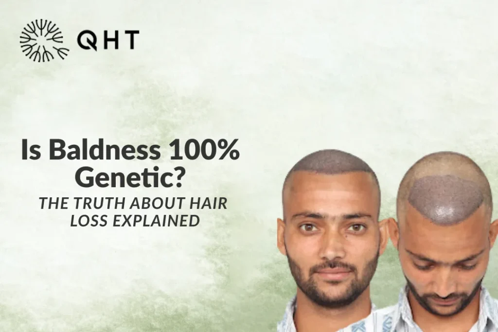 Is Baldness 100% Genetic? The Truth About Hair Loss Explained