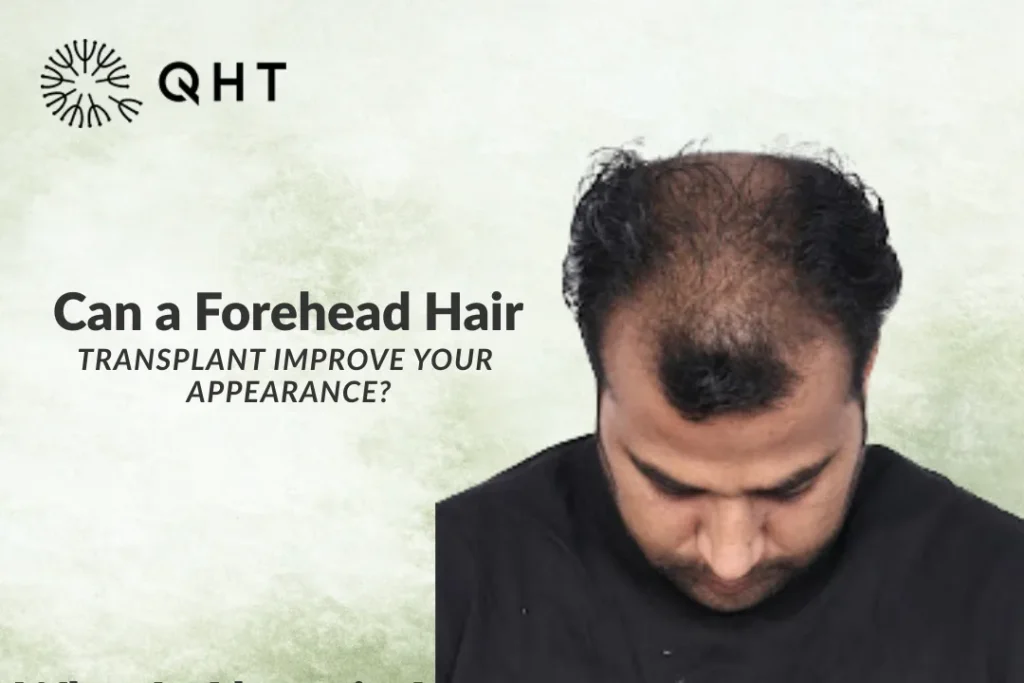 Can a Forehead Hair Transplant Improve Your Appearance?