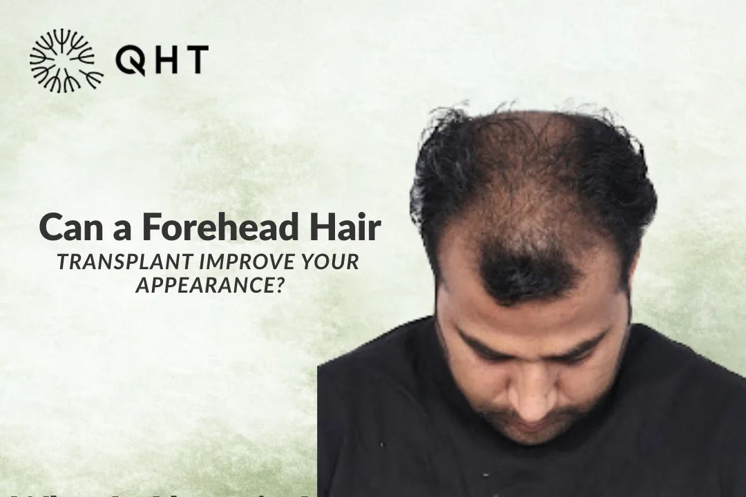 Can a Forehead Hair Transplant Improve Your Appearance?