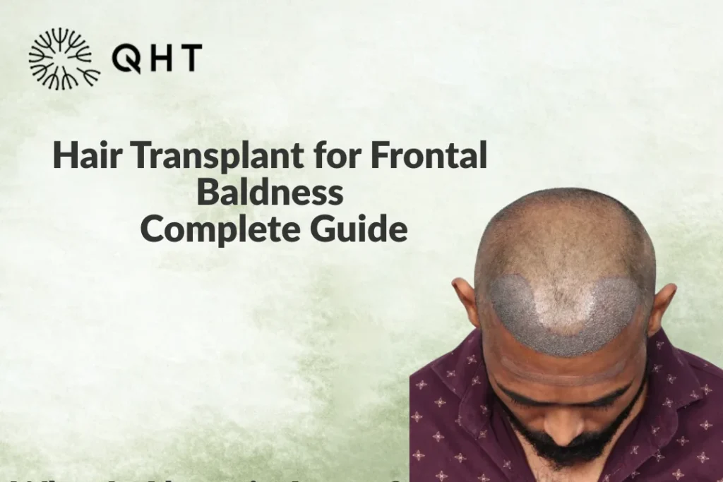 Hair Transplant for Frontal Baldness: Complete Guide
