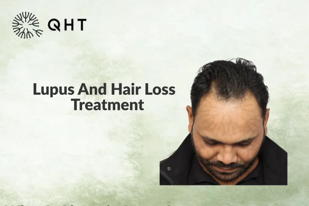 Lupus And Hair Loss – Treatment