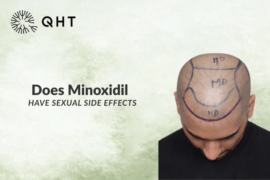 Does Minoxidil Have Sexual Side Effects