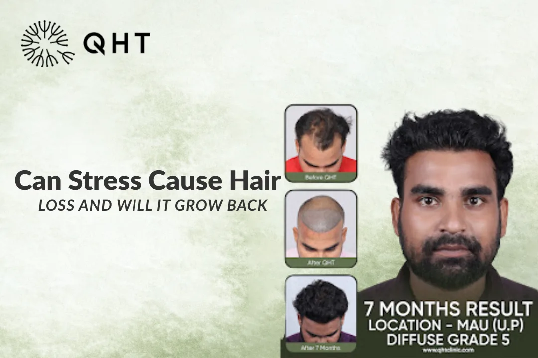 Can Stress Cause Hair Loss and Will it Grow Back?