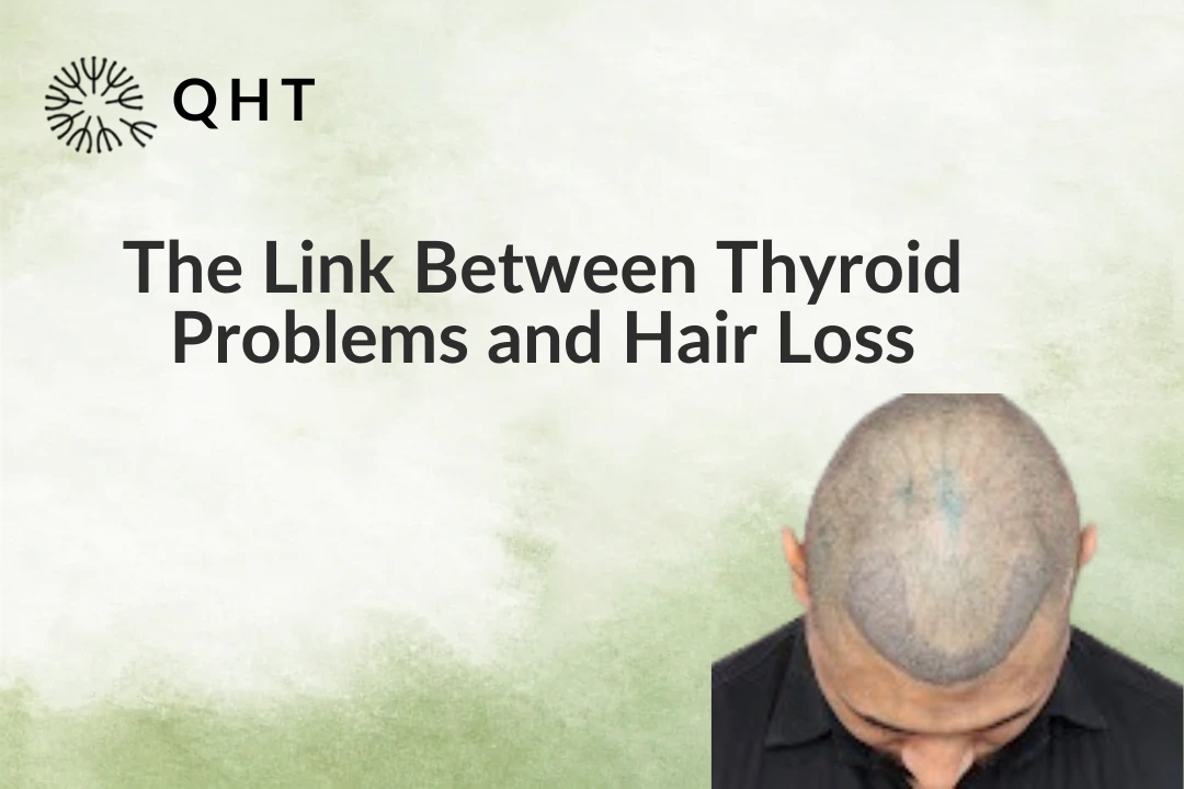The Link Between Thyroid Problems and Hair Loss