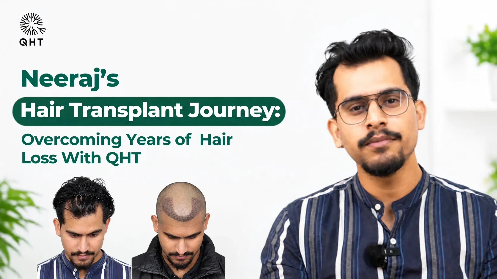 QHT Patient hair transplant Journey