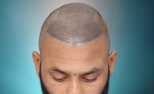 after transformation